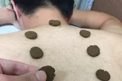 中醫「三伏貼療法」開跑！醫：8月底前是治療最佳時機