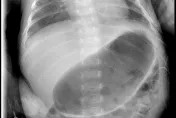 你的孩子常「噴射性」嘔吐？小心是嬰兒肥厚性幽門狹窄