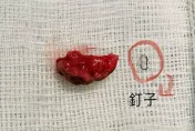 愛愛時小兄弟總是有「腫凸感」？切開一看包皮上竟有「釘子」