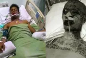 滴眼藥水竟罹罕病　男「全身爆疹」臉爛瀕死…妻喊還有救求幫助