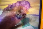 有圖慎入！72歲嬤足部傷口潰爛　醫「夾出近10隻蛆」噁爆