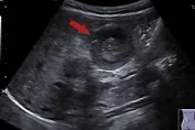 嬰幼兒染「腺病毒」後哭鬧不安！醫示警：「腸套疊」嚴重恐腹膜炎