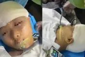 9歲女上課遭爆頭「插玻璃流腦漿」！男師竟先偷帶去縫合　開顱5小時命危