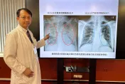恐怖流感！64歲男呼吸困難變重症　中榮俯臥治療、葉克膜救命!