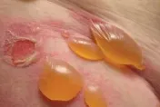 老伯全身發癢、起水泡竟是「類天皰瘡」惹禍！醫：抓破恐引發感染致死