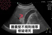 有圖慎入！壯男的膽「腫如士林大香腸」　醫照驚呼：不得了了