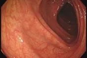 小息肉別輕忽！竟是「0期大腸癌」　醫PO照：大家一起抓鬼