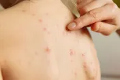 背部痘痘狂長？皮膚醫點名「8個壞習慣」揹背包、用力刷都錯