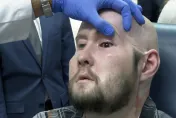遭電擊毀容！美國男接受全球首例「全眼移植」　可望重見光明