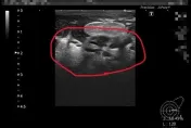 少婦乳房冒硬塊腫痛潰爛！竟染「古老結核菌」醫：150年不到600例