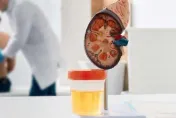 她頻尿、夜尿不理！水腫就醫罹「腎病第四期」醫曝4原因恐洗腎