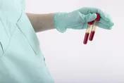 一滴血就能揪出胰臟癌　台大最新研究解癌王魔咒