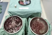 慎入!她肚子半年變超大！醫狂撈「2盆4公斤軟稠黏液」驚悚照曝光