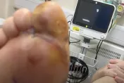 郵輪驚魂！英男睡醒腳趾腫脹發紫　切開爆白膿驚見「蜘蛛卵」