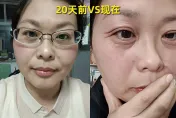 影/20天變7旬嬤？42歲OL曬素顏照稱遇「斷崖式衰老」　專家：男性更早出現