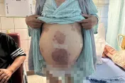 不是孕婦！肝癌男「滿肚腹水」只能換肝　因「死去的外國人」器官捐贈重生