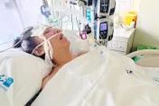 洪曉蕾插管續命！醫曝「脖子裡面都是膿」　還原病程：腫得像浮屍