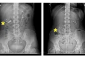 女高中生腰痠又頻尿　一照腎臟超音波驚見「腎下垂」！醫曝：纖細身材是原因