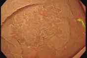 才照完大腸鏡正常！「1年後驚見息肉」醫揭驚人真相：當心大腸間隔癌