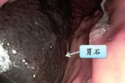 8旬老翁胃痛求診　照胃鏡驚見「5公分大黑石」！醫授：喝可樂軟化結石