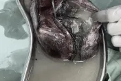 慎入！她腹部劇痛就醫挖出「一坨20cm肉球」　醫驚呼「還有頭皮＋長髮」嚇傻