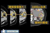 70歲婦後腹腔大出血送醫　竟是腎臟腫瘤破裂！ 醫曝可能原因：推拿要小心