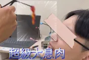影/慎入！「8公分長鼻息肉」取出　20歲男眼角泛淚「可以呼吸的感動」