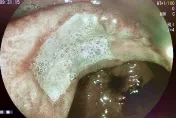40歲女性長期噁心腹脹　切片化驗確診為胃黏膜淋巴瘤