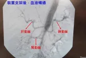 43歲男子肚子劇痛　就醫一看竟然是「主動脈剝離」惹禍！