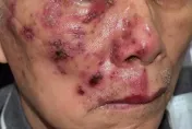 7旬嬤皮膚乾癢痛不欲生！檢查竟是「帶狀皰疹」惹禍