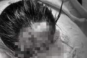 驚人傷勢曝光！Toyz頭破一個大洞「縫了至少10多針」　網怒批「要殺人是不是？」