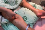 偉大的模仿者！輕熟女「腹痛、下肢水腫、腦病變」罹狼瘡性腸繫膜血管炎