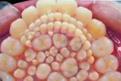 有圖！5歲童罹罕病長滿「300顆牙齒」超密集照片曝