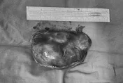 有圖！老婦後腿摸到腫塊...7天後「悄悄長大了」　化驗結果竟是惡性肉瘤