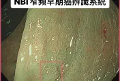 1瘜肉25%恐變大腸癌！35歲女檢出2cm鋸齒狀瘜肉！醫曝：糞便潛血恐檢查不到