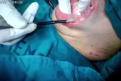 有圖超噁！男遊秘魯遭馬蠅寄生「腫成香腸嘴」孵出3隻2.5公分肥蟲