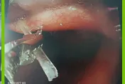 7旬翁「魚刺卡喉嚨」弄不出來！　胃鏡一照醫驚：巨大魚刺整根插入
