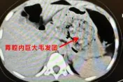 5歲女童腹痛難耐！醫從胃裡取出「一大坨毛髮」　確診為「長髮公主症候群」