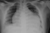 發燒、肌肉痠痛　誤認感冒險猝死！醫揭「急性心肌炎」4症狀須警覺
