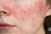 23歲女「以為病好了」自行停藥！紅斑性狼瘡復發　腎臟衰竭險洗腎