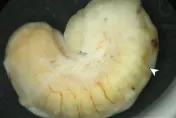 她眼球長「腫塊」拖2年才就醫！驚見寄生蟲蠕動　疑吃鱷魚肉感染