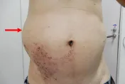 皮蛇纏腰！他右腹腫脹「以為長了壞東西」竟是帶狀疱疹併發症作怪