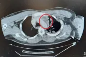 車禍撞擊「主動脈剝離」致死率極高！8成到院前離世