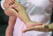 腸病毒疫情升溫！　醫曝「5歲以下」死亡率最高：沒有特效藥或疫苗