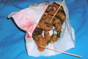 28歲女「每天一包鹹酥雞」養出大腸癌！醫揭誘發息肉危險因子