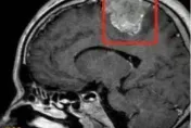 32歲男穿不住夾腳拖鞋！　一檢查竟是「6公分腦瘤」惹禍