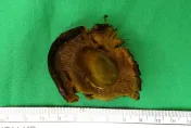 男童肚子痛狂吐2天！急剖腹「取出整朵香菇」認了：不喜歡直接吞