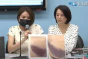 影/陳菁徽痛哭曝傷勢照片！臀部、腰部遭鍾佳濱魔爪「超大片瘀青」怵目驚心