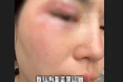 會飛的硫酸？女遭隱翅蟲襲眼「隔天眼周潰爛起泡」 醫生：千萬不可打