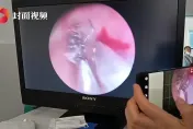 影/頭暈耳鳴2週求診…醫一照耳鏡手抖了　「活蟲在爬」鼓膜上還有「白芝麻」